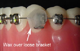 Wax Over Loose Bracket