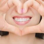 Dental braces in happy womans mouths through the heart. Brackets on the teeth after whitening. Self-ligating brackets with metal ties and gray elastics or rubber bands for perfect smile. Orthodontic teeth treatment.