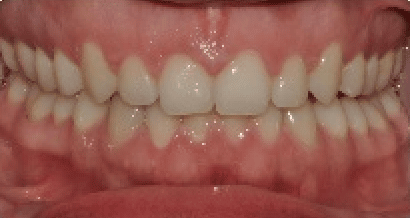 Invisalign_case2_after