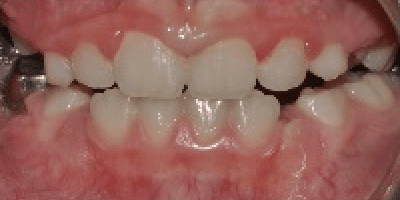Invisalign_case3_after