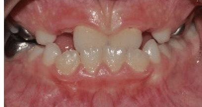 Invisalign_case3_before