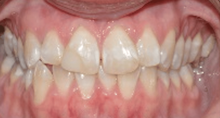 Invisalign_case_1-1