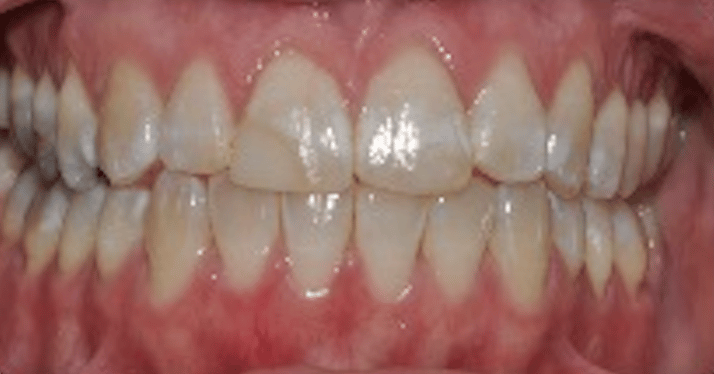 Invisalign_case_1-2