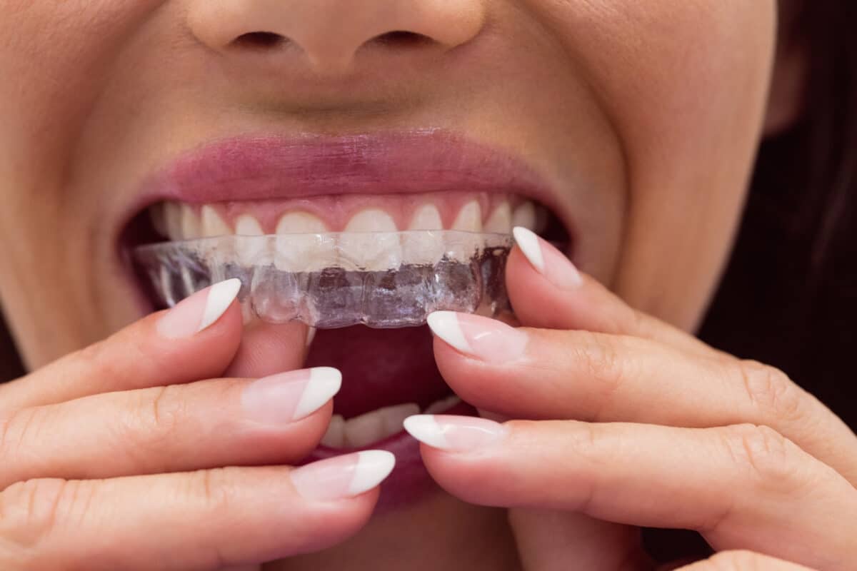 Close-up of female patient wearing invisalign clear aligners